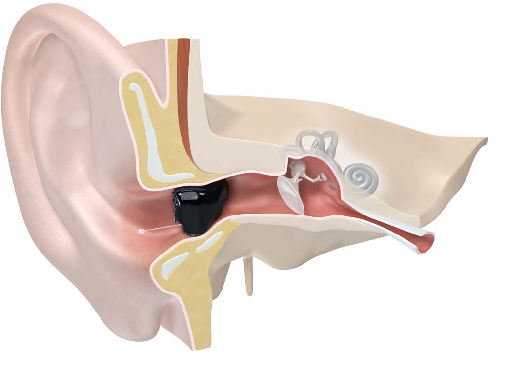 Ein CIC-Hörgerät, das korrekt im Gehörgang sitzt