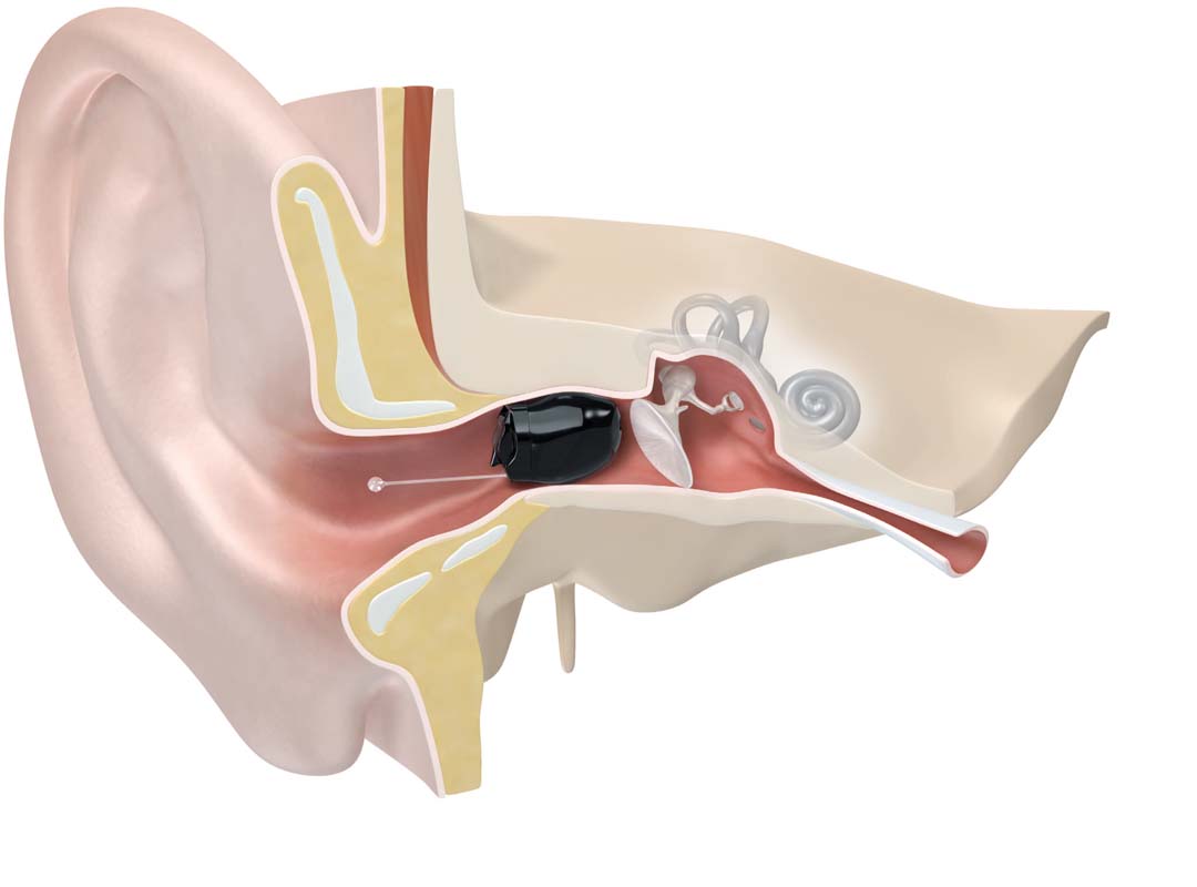 Abbildung eines korrekt im Gehörgang sitzenden IIC-Hörgeräts