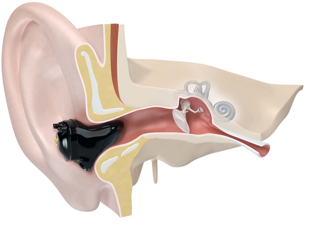 Ein ITC-Hörgerät, das korrekt im Gehörgang sitzt