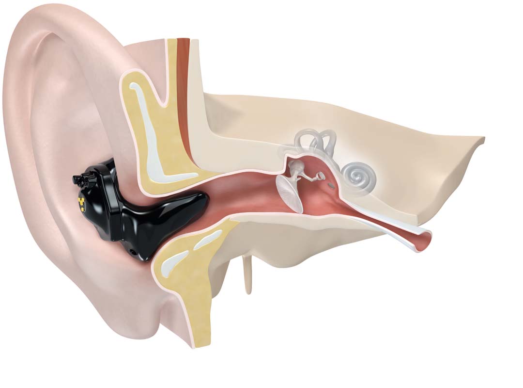 Ein ITE-Hörgerät, das korrekt im Gehörgang sitzt